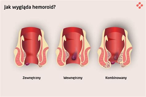 Leczenie przewlekłych hemoroidów